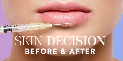 Skin Decision: Before and After